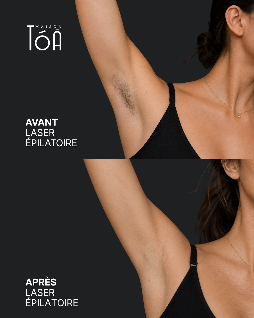 Avant Après profhilo