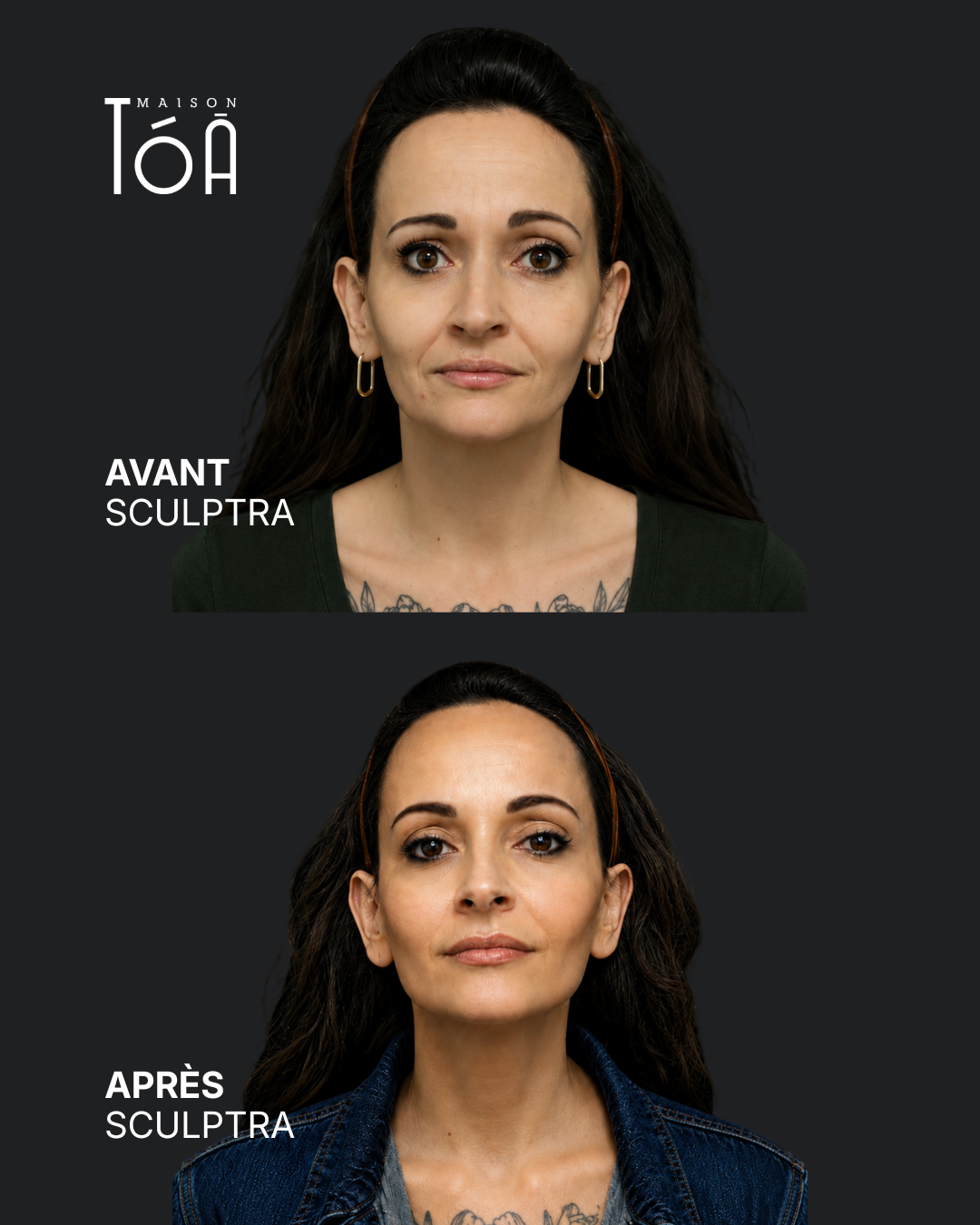 Avant Après profhilo