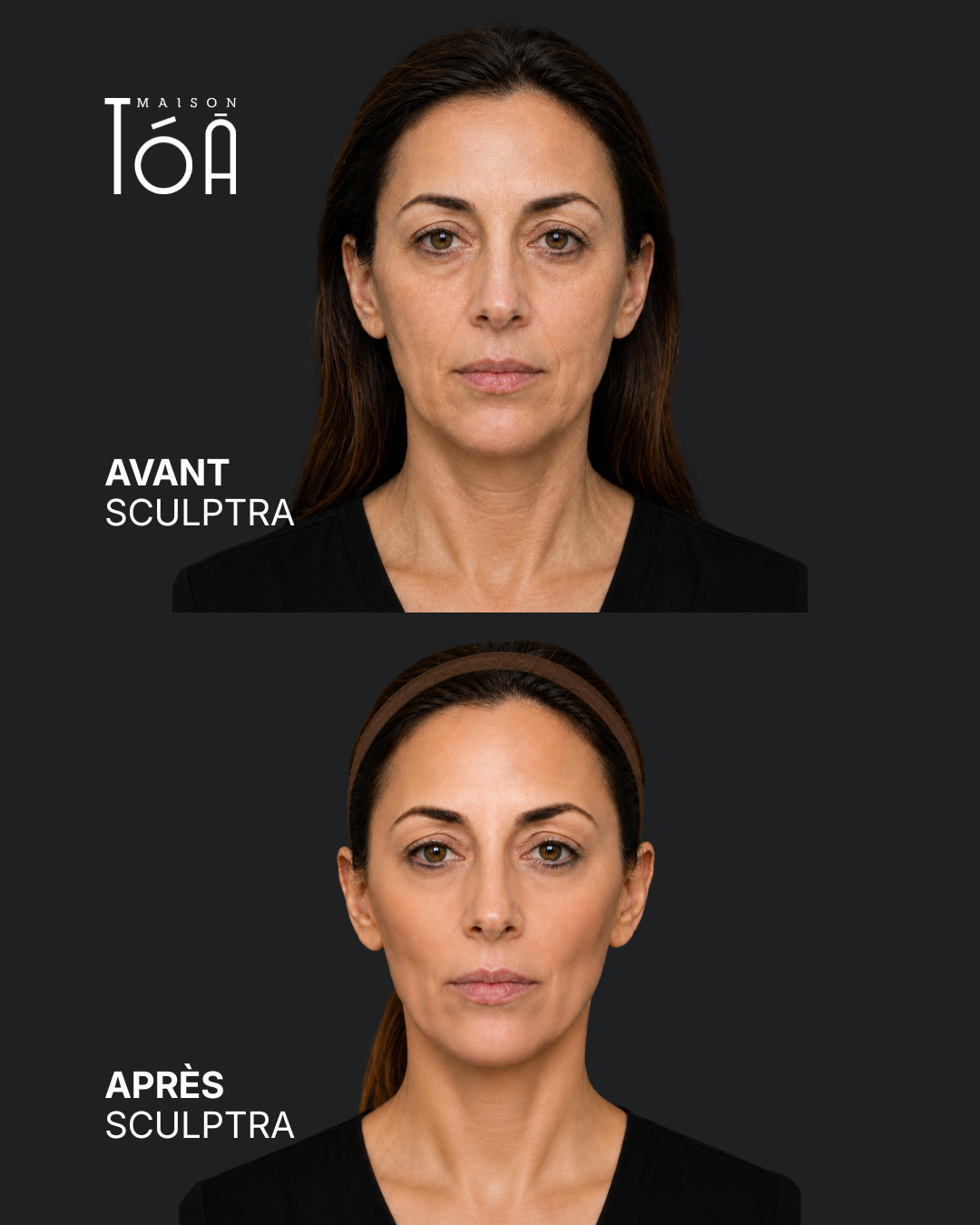 Avant Après profhilo 