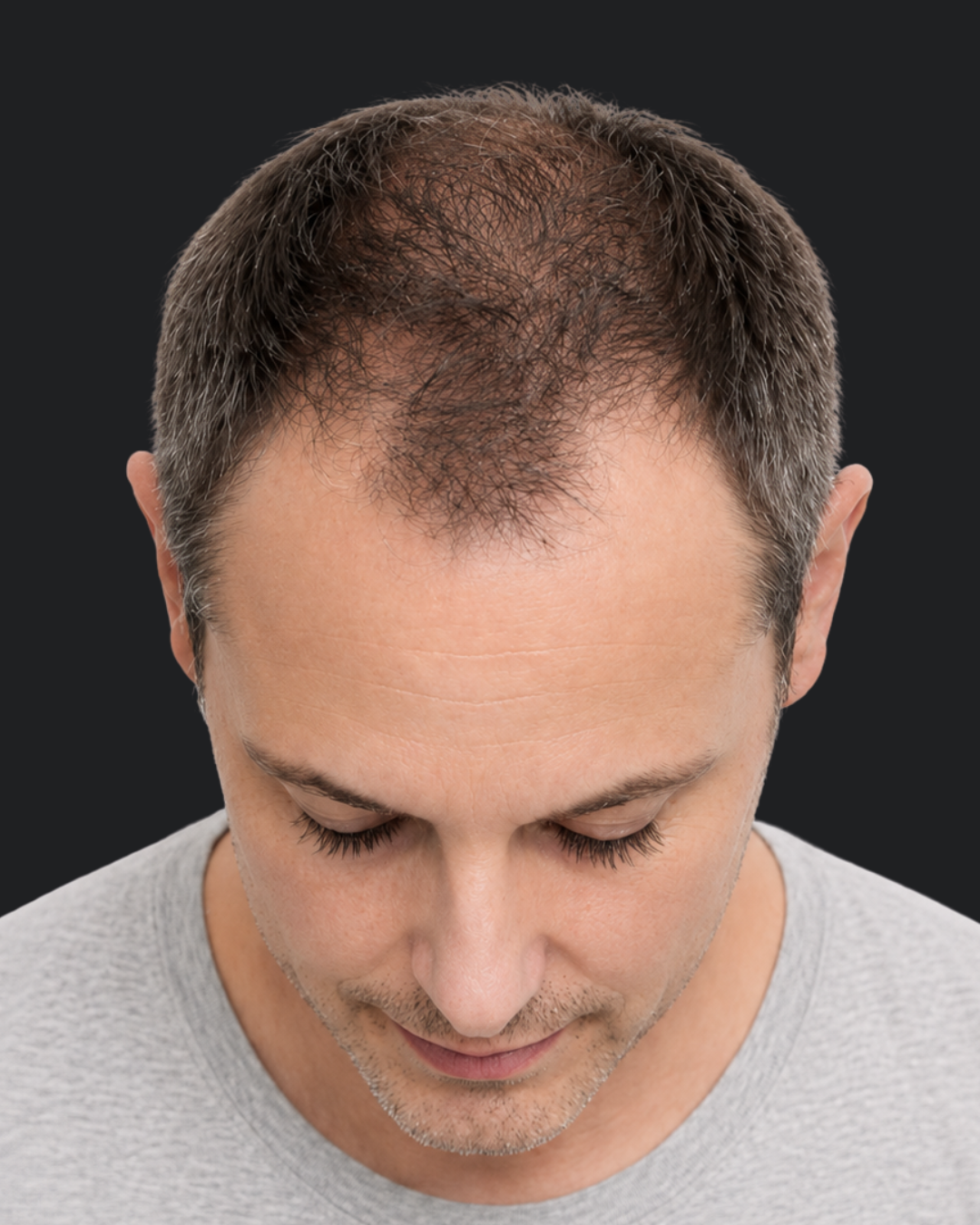 Exosomes - Cheveux 3 1 2