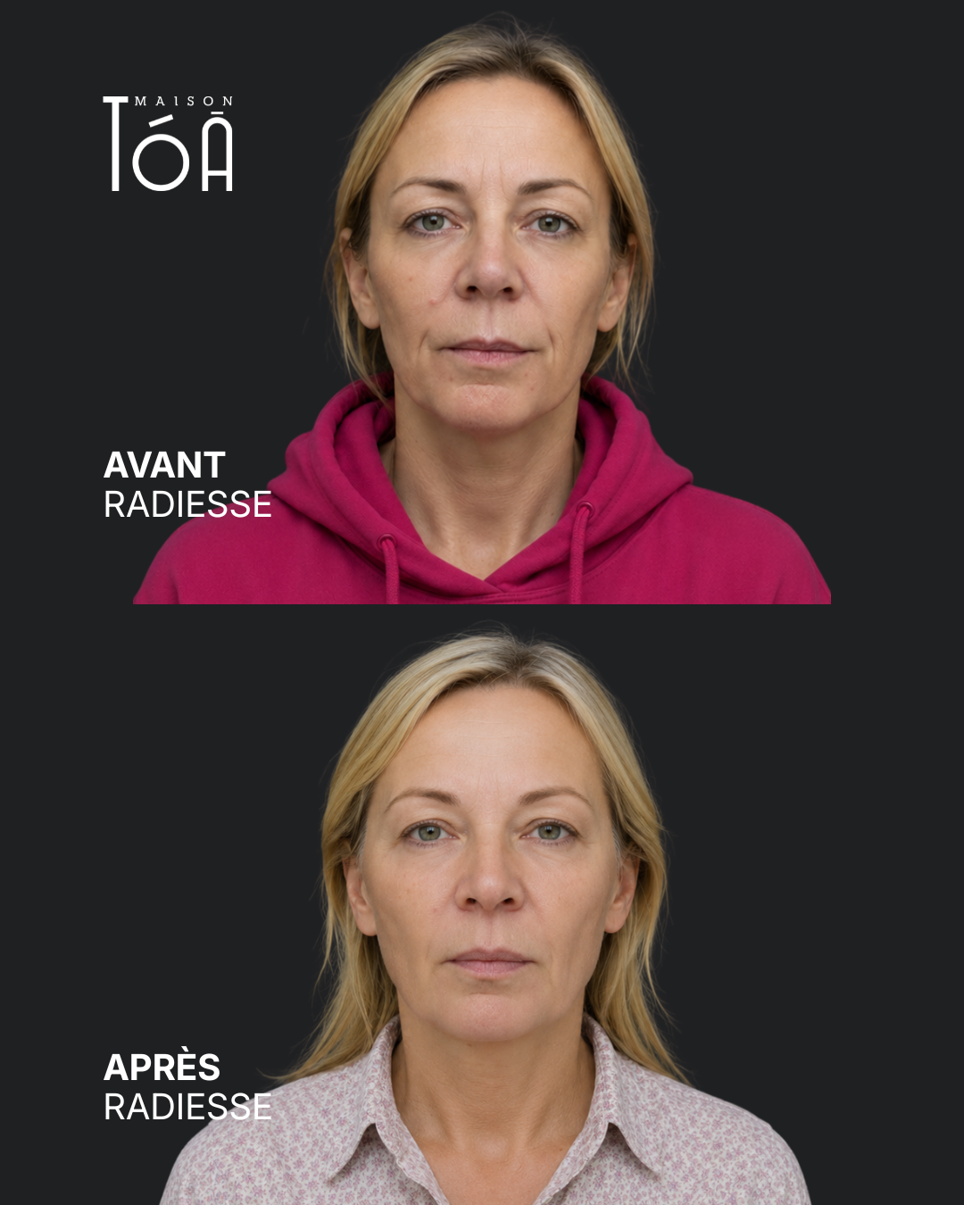 Radiesse 5 avant après radiesse