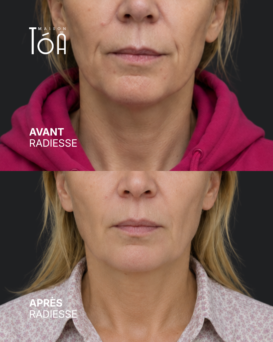 Radiesse 6 avant après radiesse