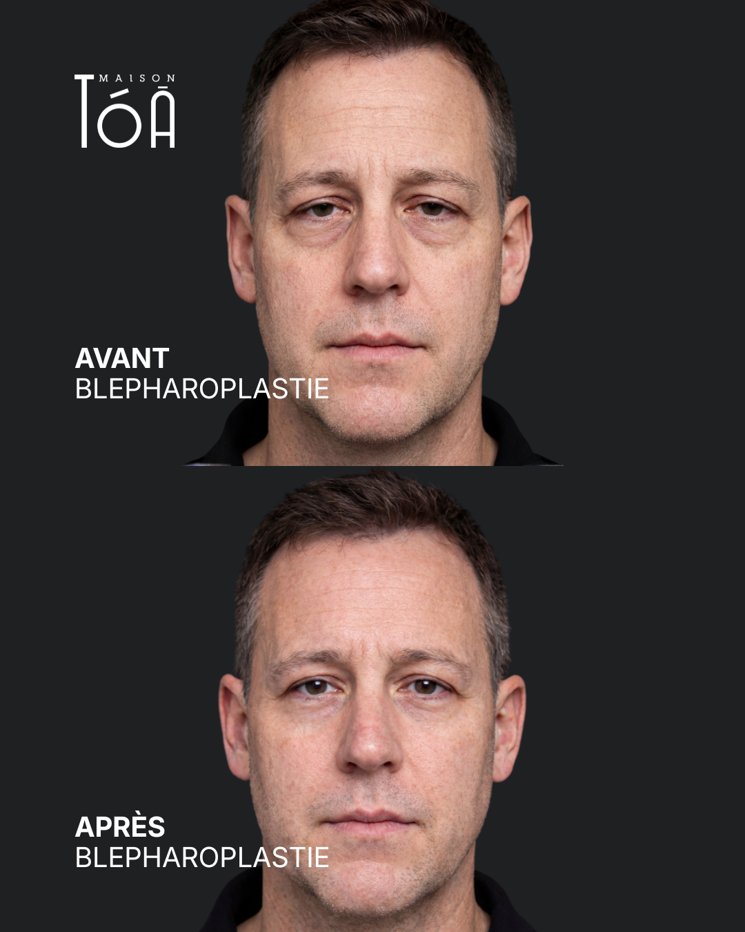 Blépharoplastie 5 Blépharoplastie avant après