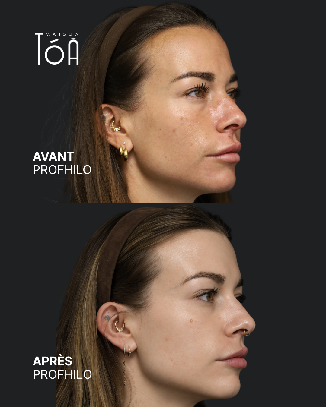 Profhilo® 7 Avant Après profhilo
