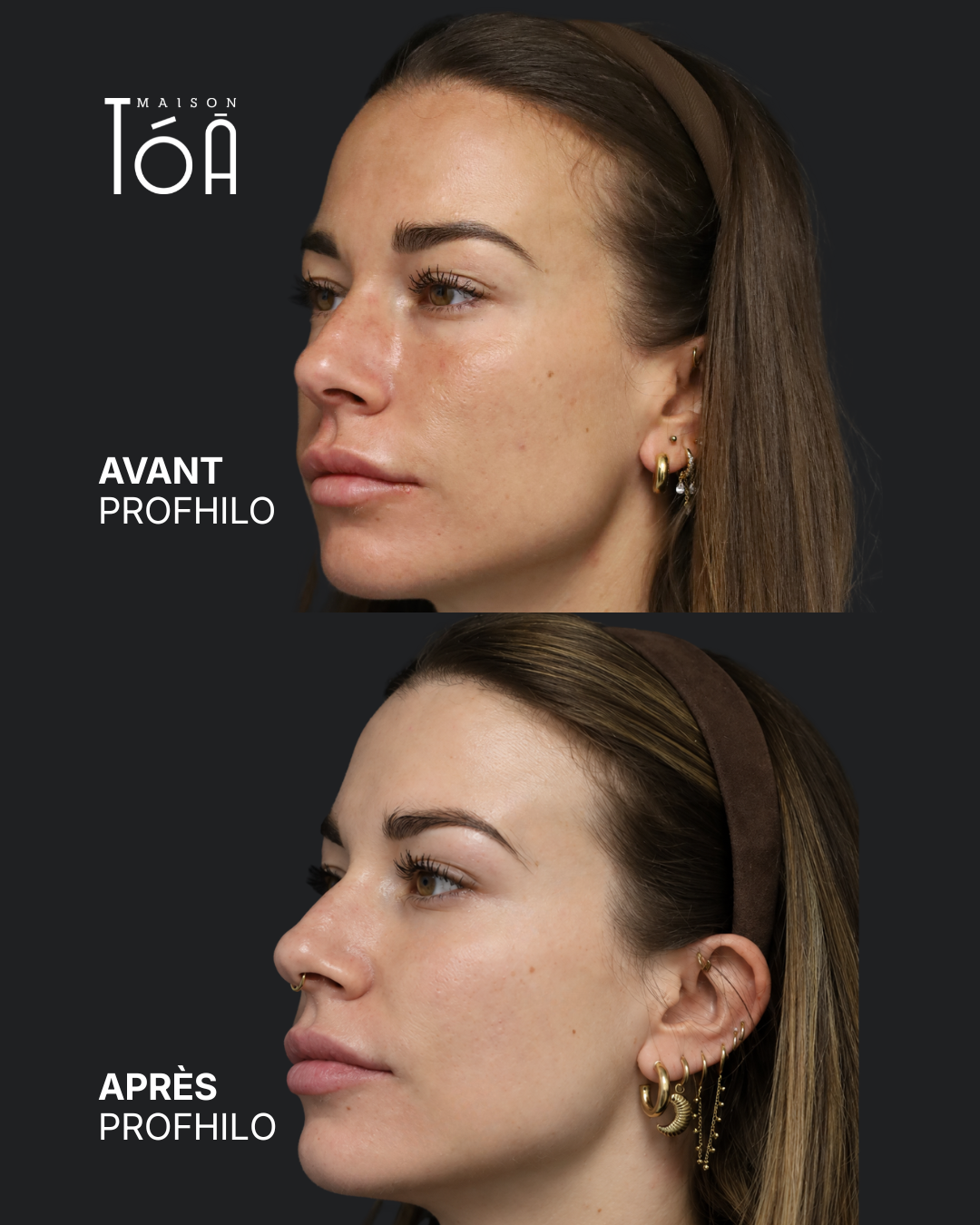 Profhilo® 6 Avant Après profhilo