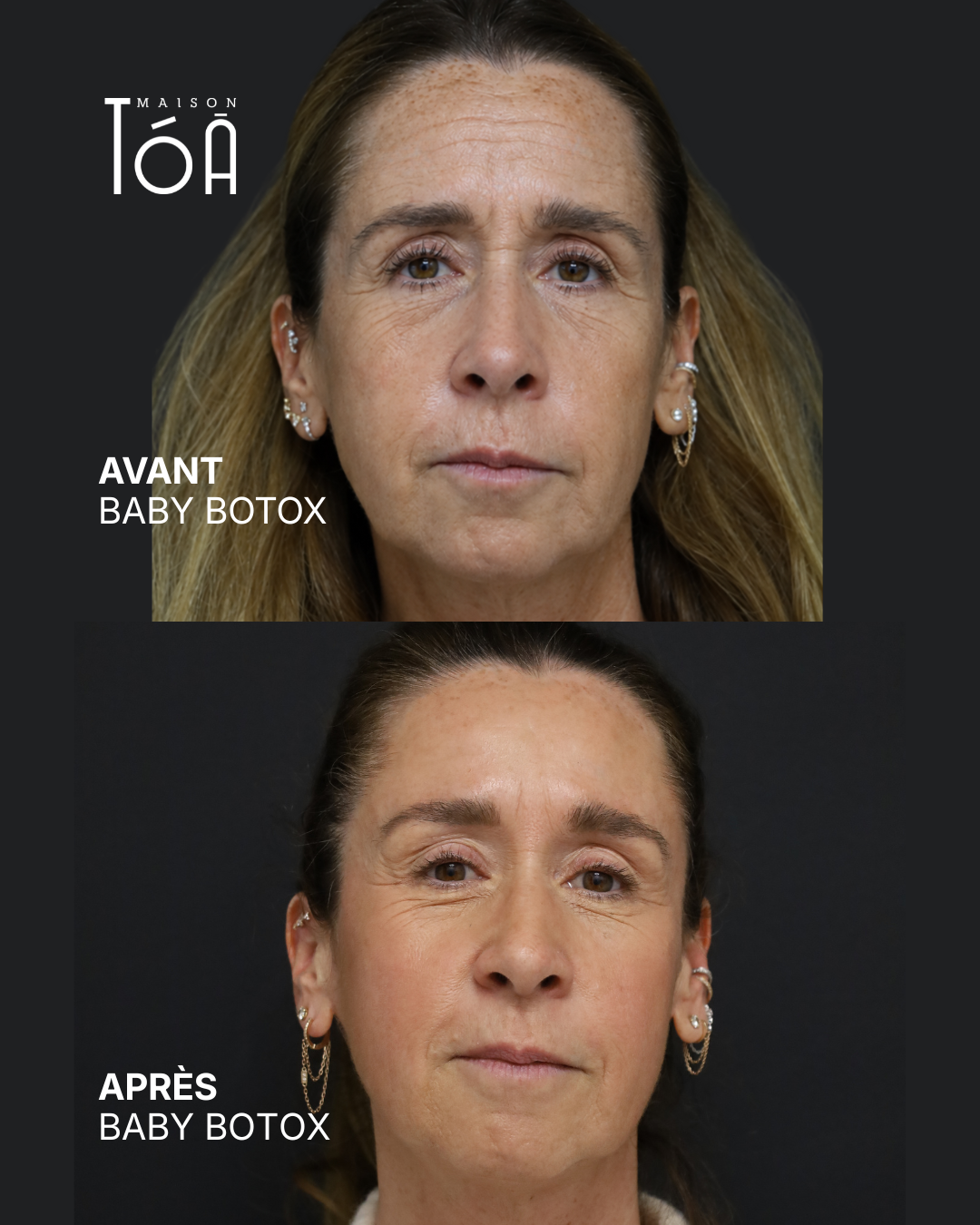 Botox 9 Avant/après toxine botulique, résultat 5, Maison Tóā Lausanne