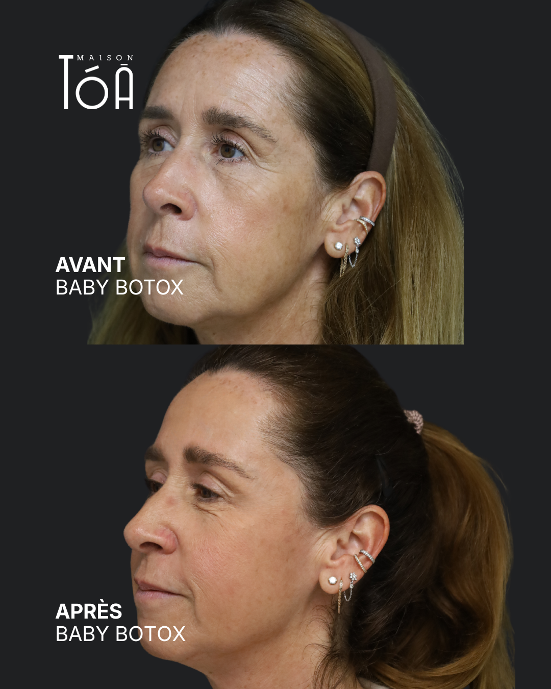 Botox 10 Avant/après toxine botulique, résultat 6, Maison Tóā Lausanne