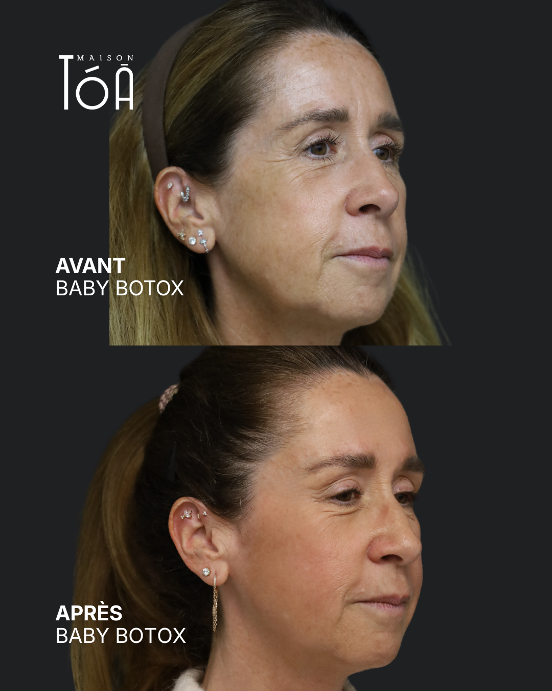 Botox 8 Avant/après toxine botulique, résultat 4, Maison Tóā Lausanne