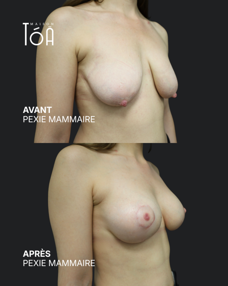 Breast pexy 14 Breast lift before/after, result 10, Maison Tóā Lausanne