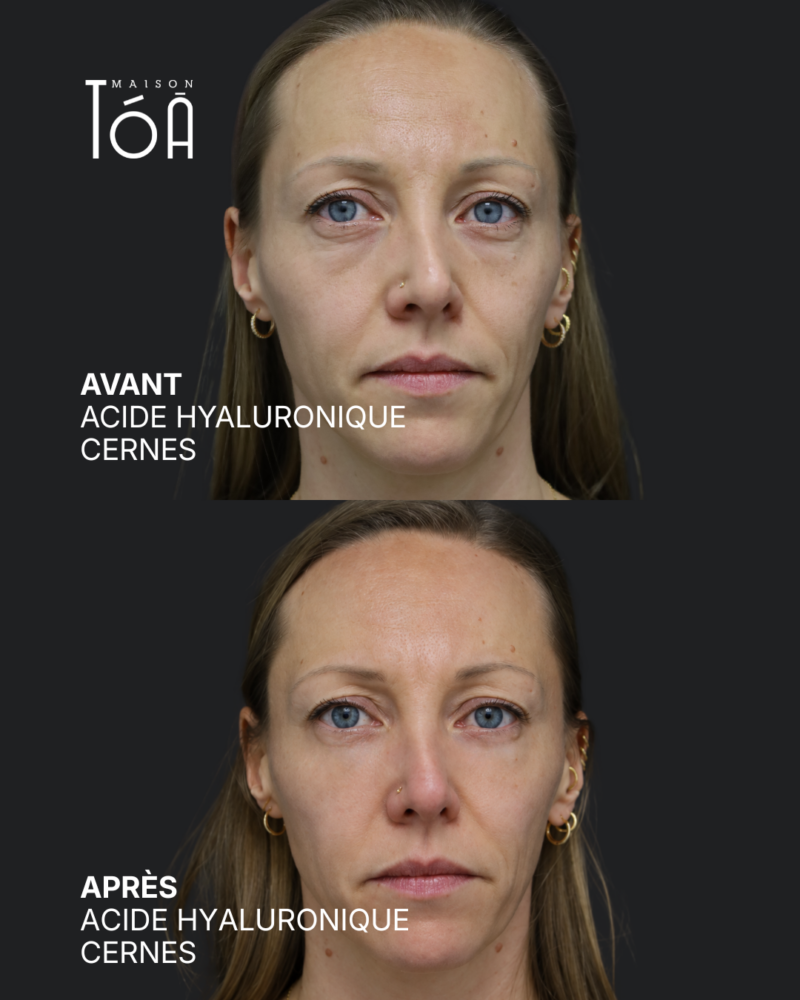 Acide hyaluronique avant après