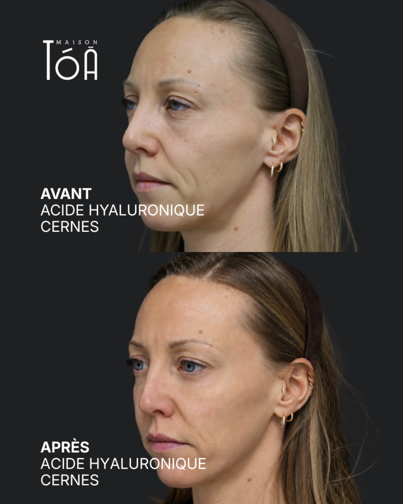 Acide hyaluronique avant après
