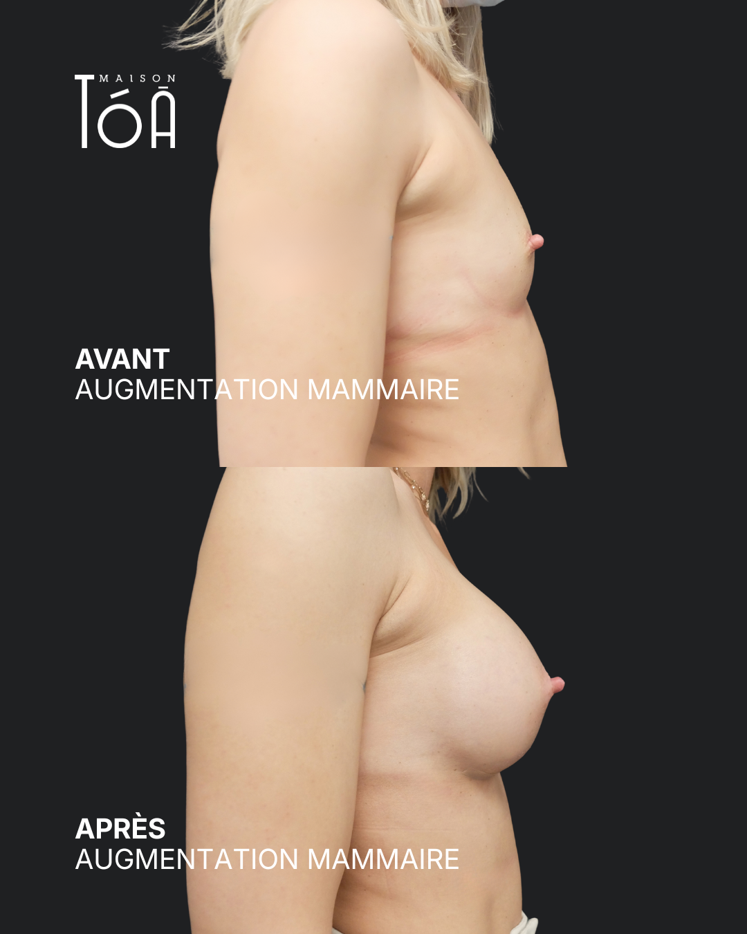 Augmentation mammaire 14 Augmentation mammaire avant/après, résultat 10, Maison Tóā Lausanne