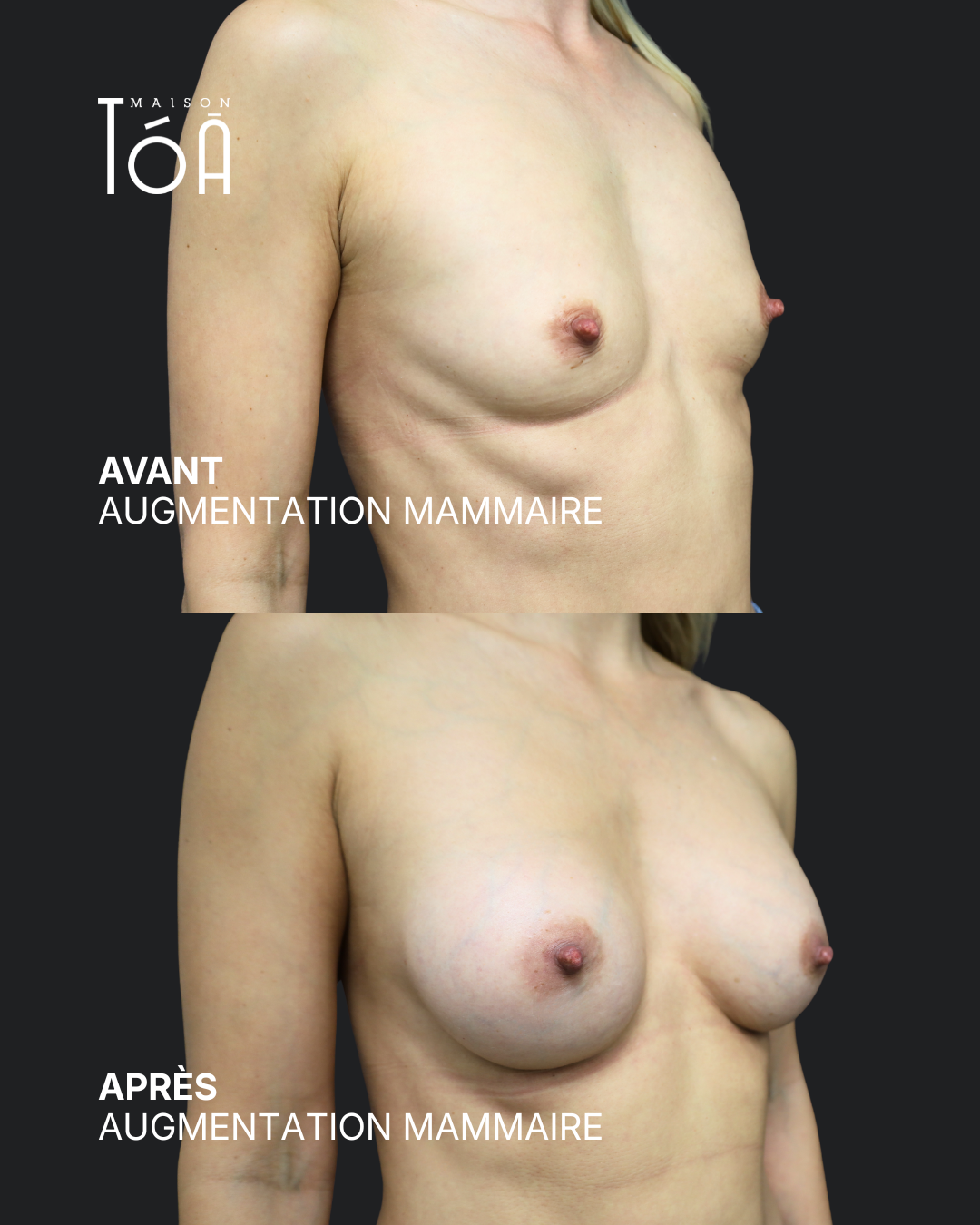 Augmentation mammaire 5 Augmentation mammaire avant/après, résultat 1, Maison Tóā Lausanne