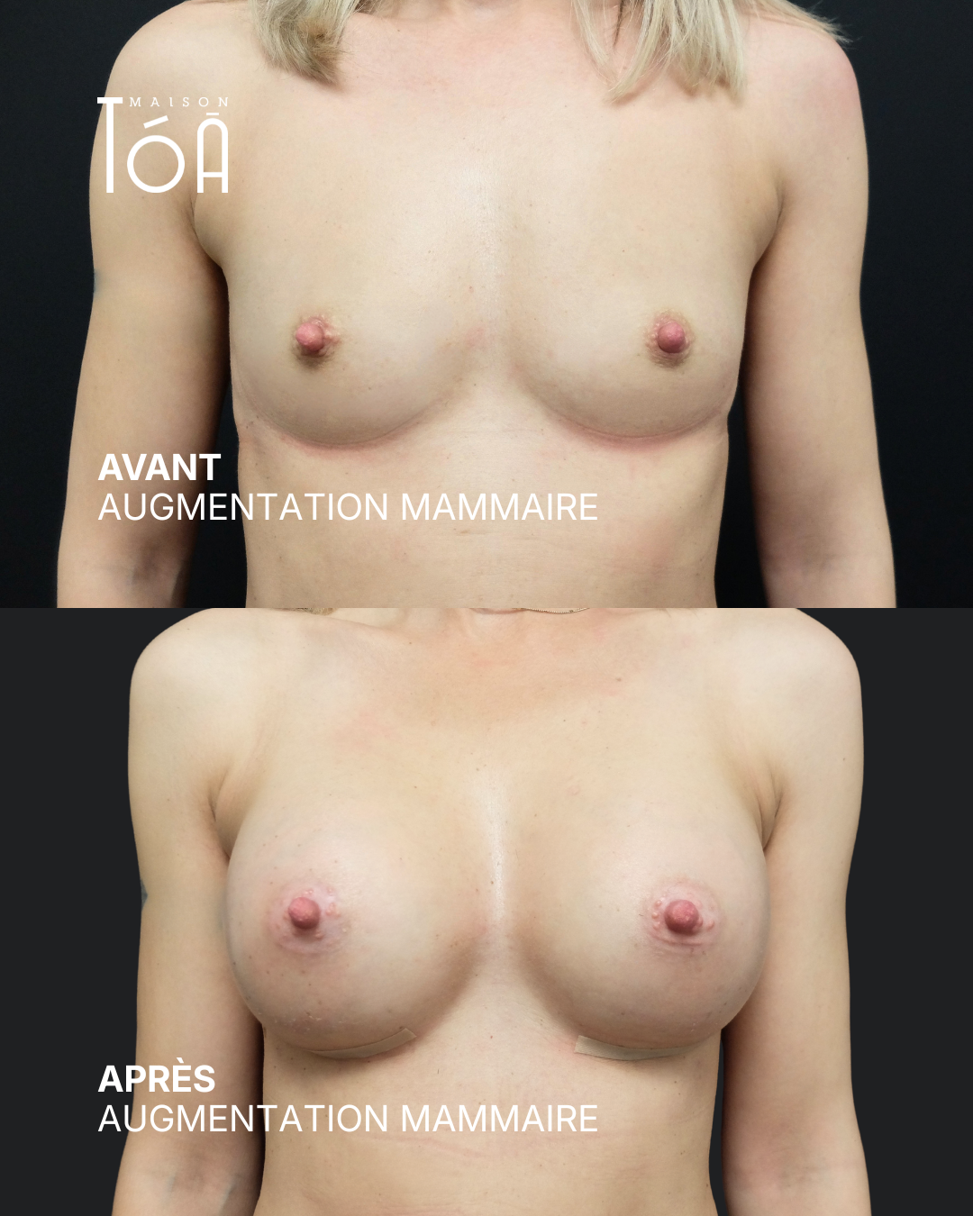 Augmentation mammaire 12 Augmentation mammaire avant/après, résultat 8, Maison Tóā Lausanne