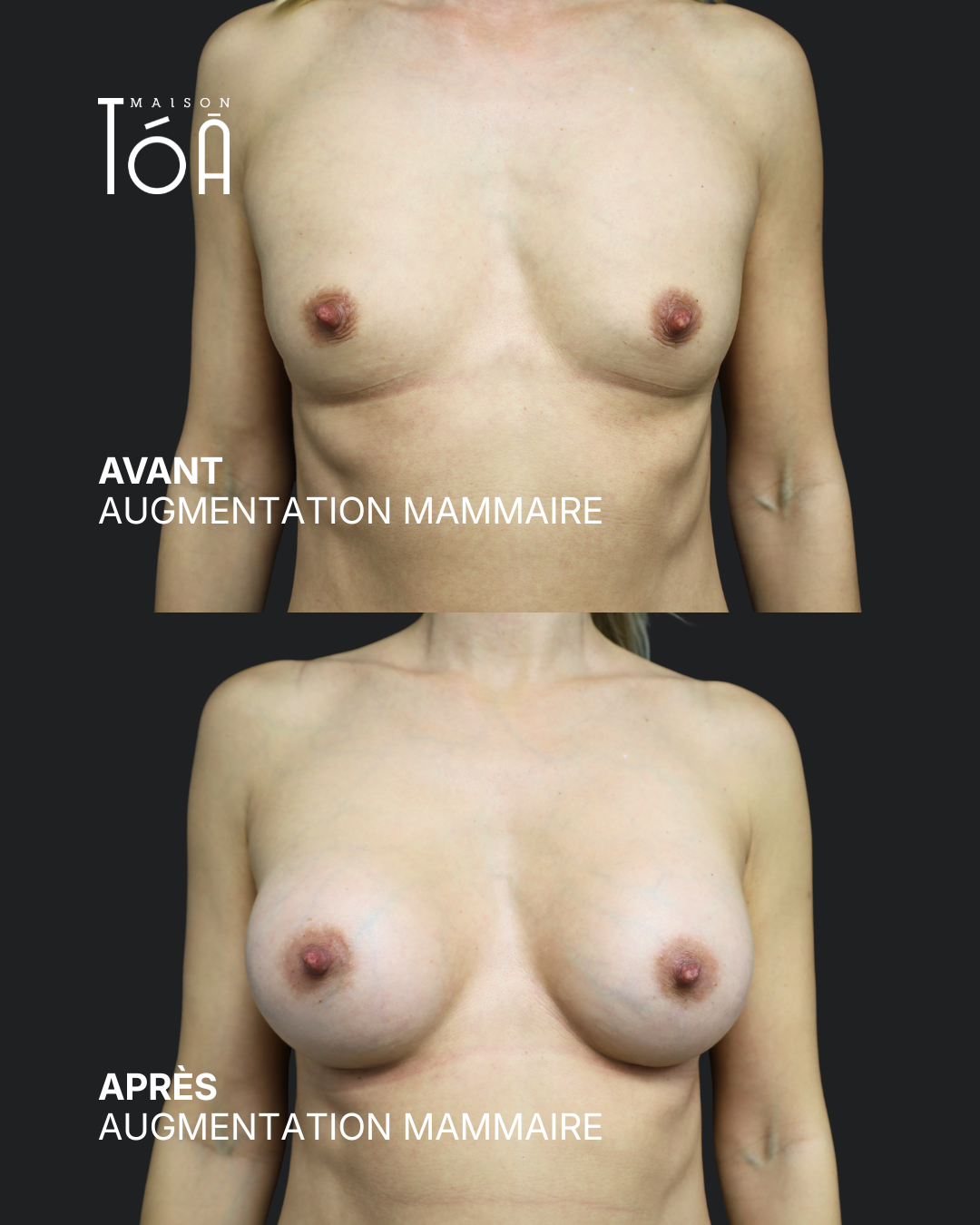 Augmentation mammaire 6 Augmentation mammaire avant/après, résultat 2, Maison Tóā Lausanne