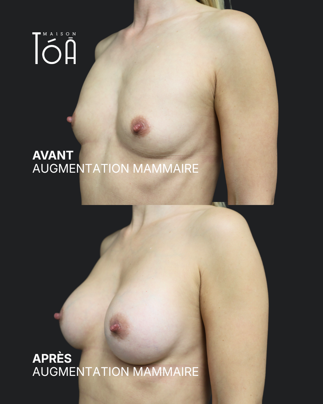 Augmentation mammaire 7 Augmentation mammaire avant/après, résultat 3, Maison Tóā Lausanne