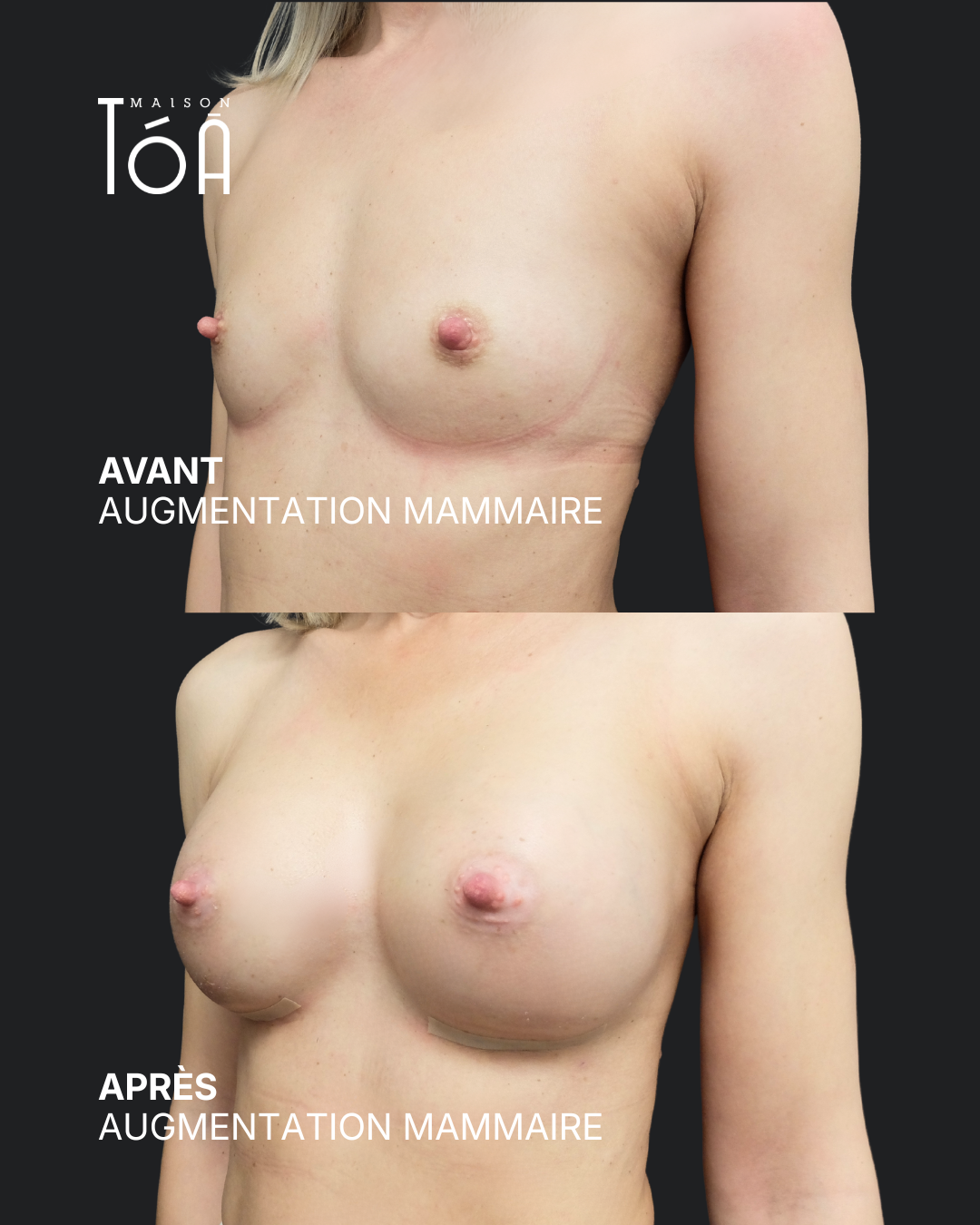 Augmentation mammaire 13 Augmentation mammaire avant/après, résultat 9, Maison Tóā Lausanne