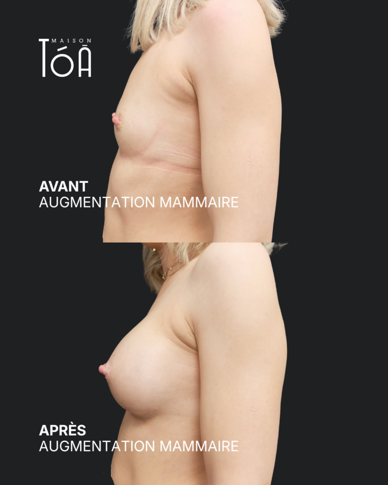 Augmentation mammaire 10 Augmentation mammaire avant/après, résultat 6, Maison Tóā Lausanne