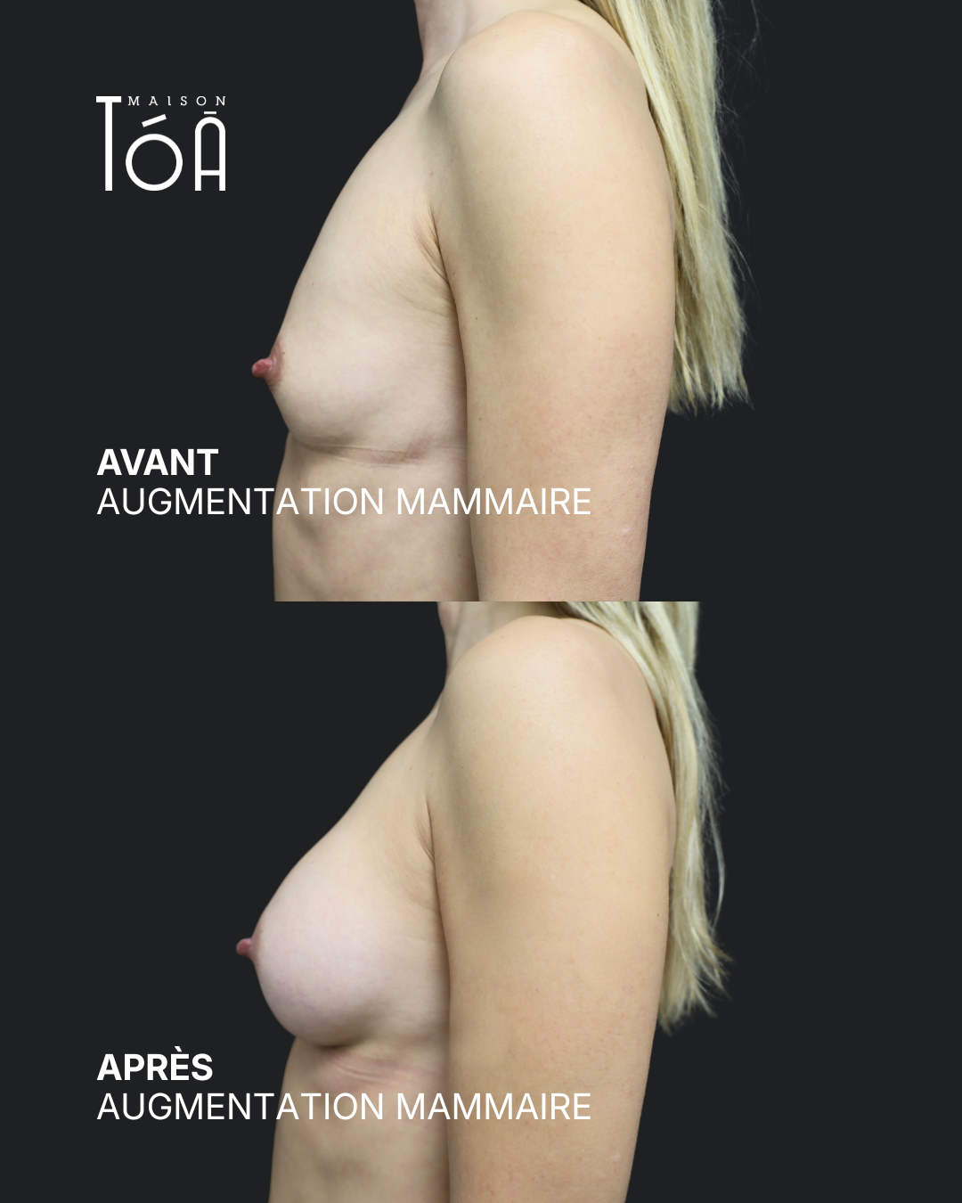 Augmentation mammaire 8 Augmentation mammaire avant/après, résultat 4, Maison Tóā Lausanne