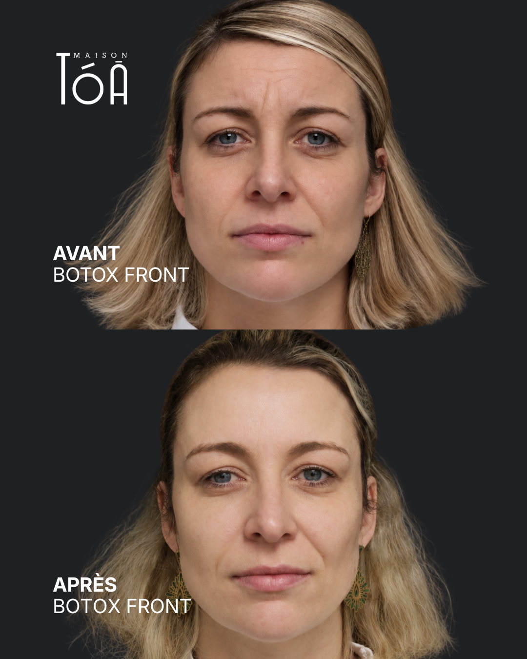 Botox 6 Avant/après toxine botulique, résultat 2, Maison Tóā Lausanne