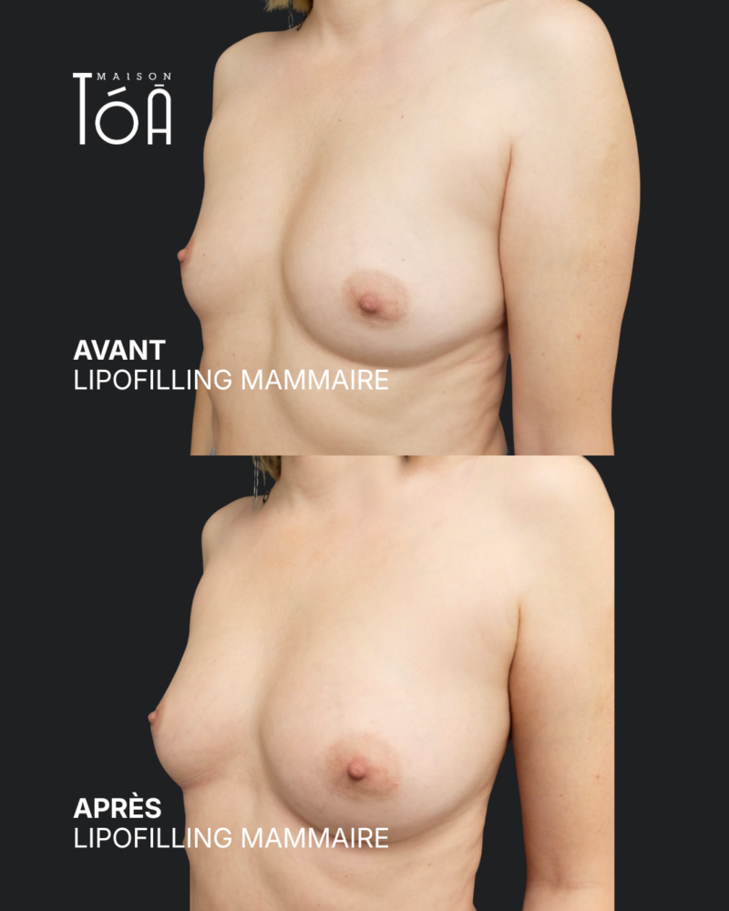 Breast lipofilling 12 Breast lipofilling before/after, result 8, Maison Tóā Lausanne
