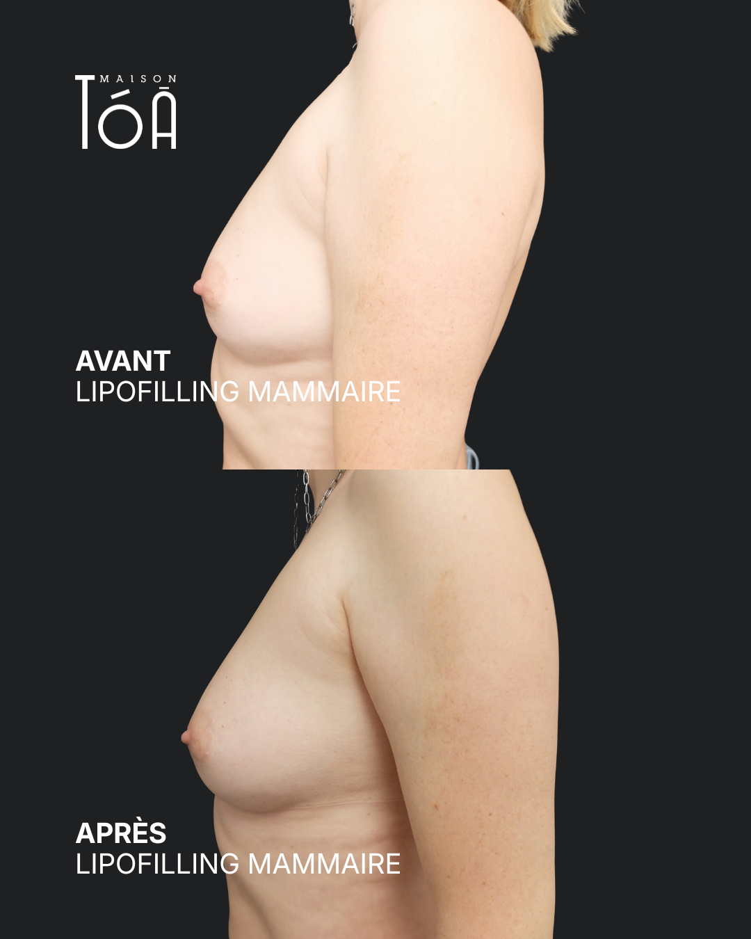 Breast lipofilling 13 Breast lipofilling before/after, result 9, Maison Tóā Lausanne