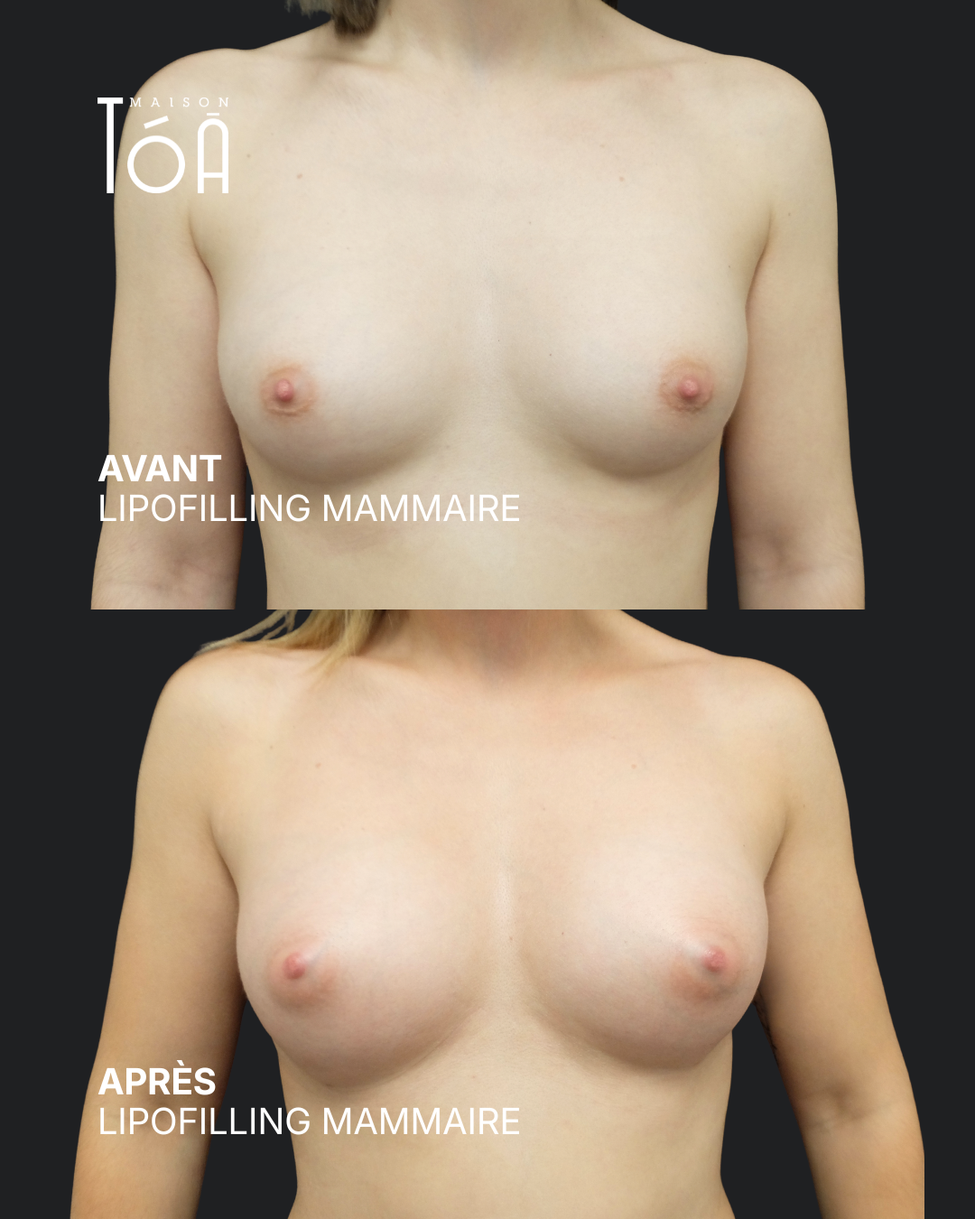 Breast lipofilling 6 Breast lipofilling before/after, result 2, Maison Tóā Lausanne