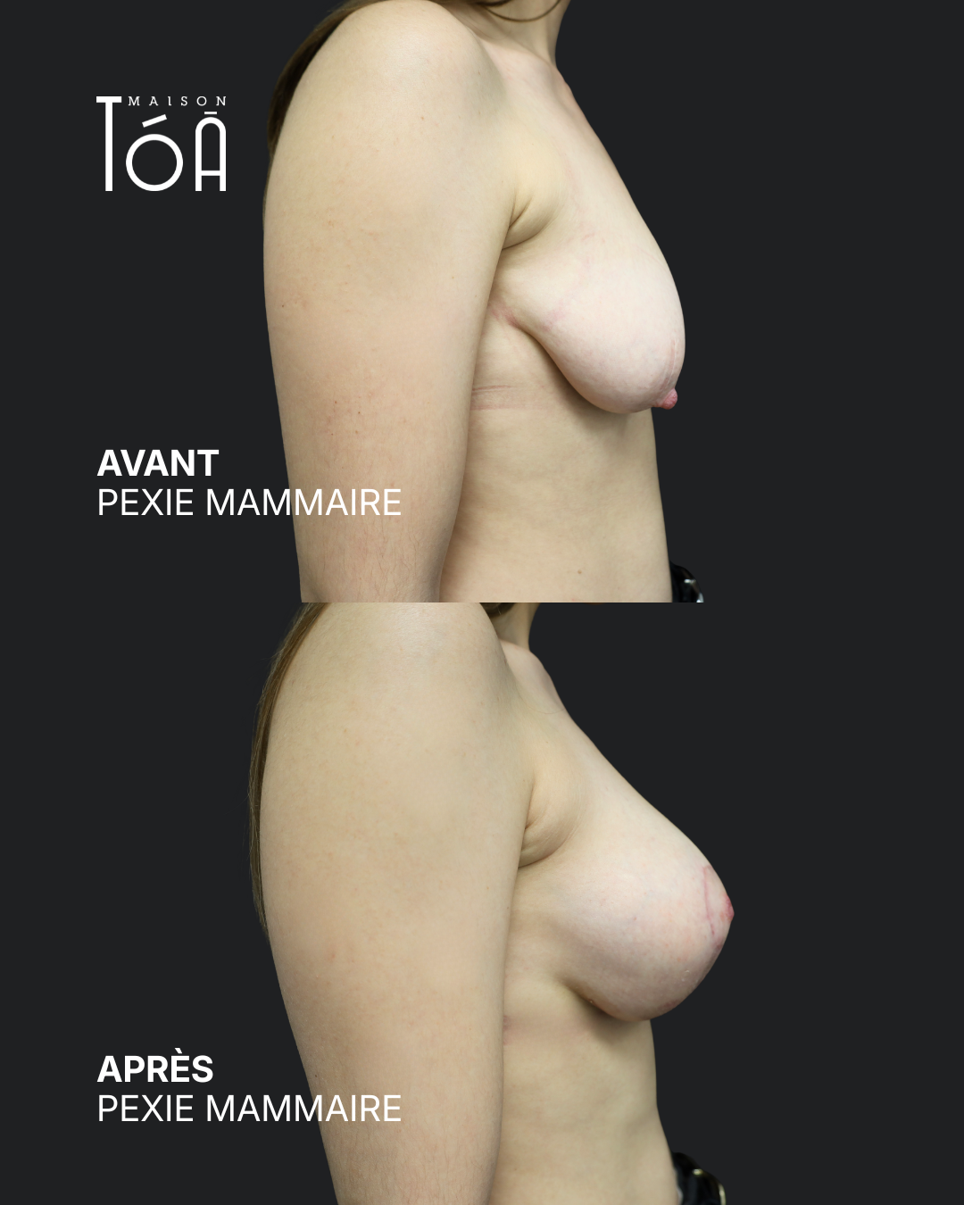 Breast lift before/after, result 8, Maison Tóā Lausanne
