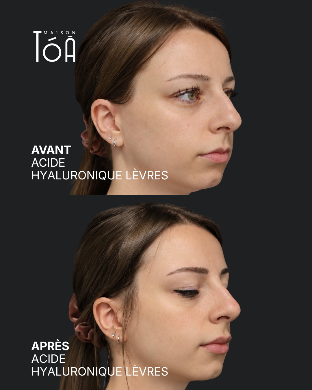 acide hyaluronique avant après lausanne