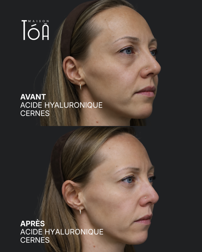 Acide hyaluronique avant après