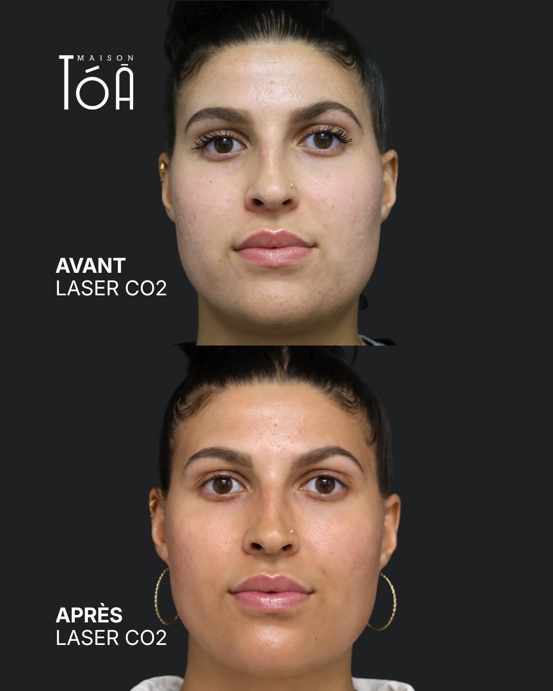 Protocole laser 25 Avant et après, laser CO2 fractionné, vue de face