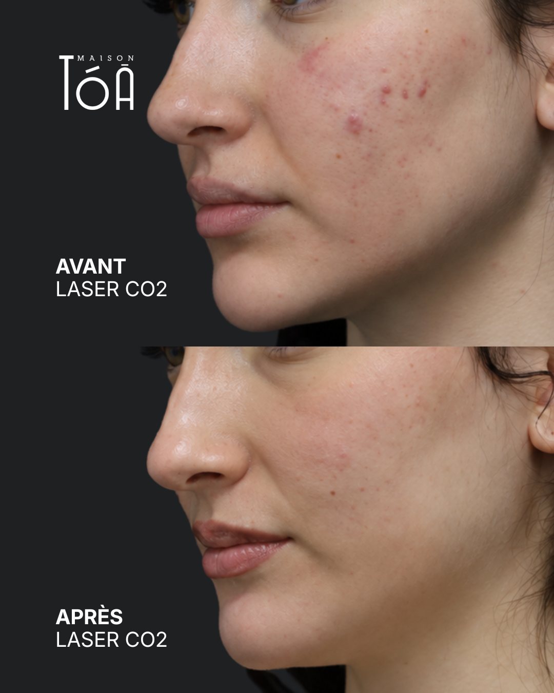 Protocole laser 32 Avant et après, laser CO2 fractionné, détail de la joue