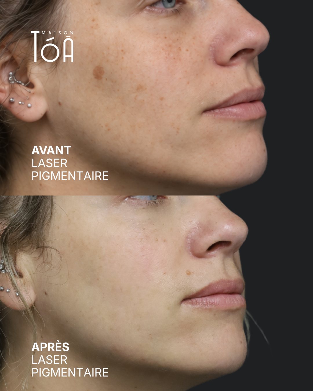 Protocole laser 12 Avant et après, laser pigmentaire, détail de la joue