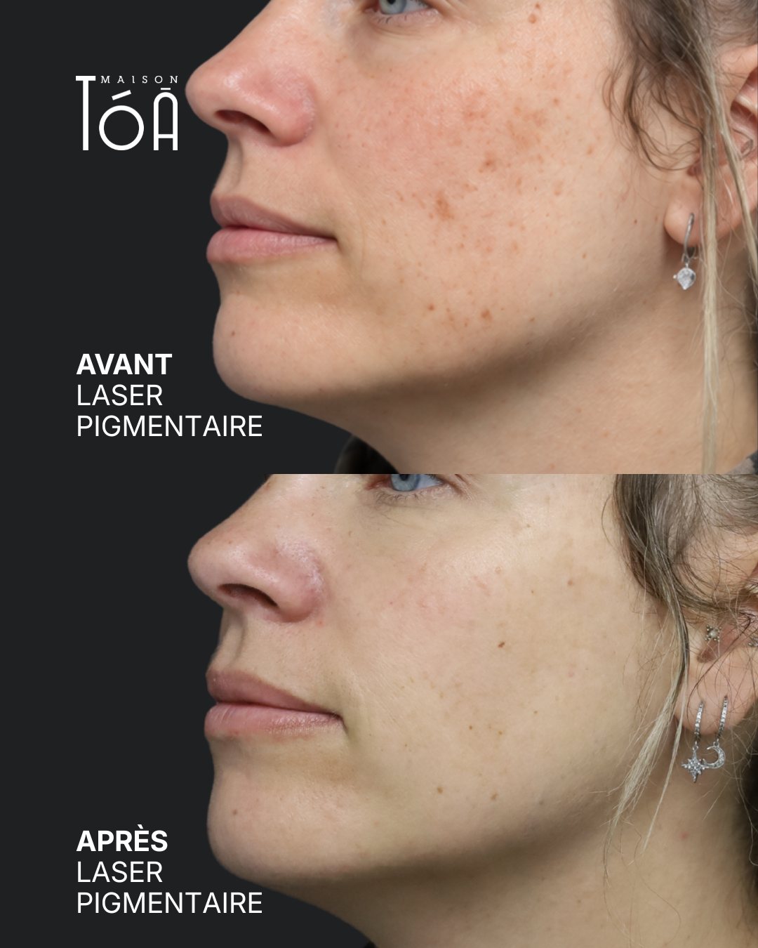 Protocole laser 10 Avant et après, laser pigmentaire, détail de la joue