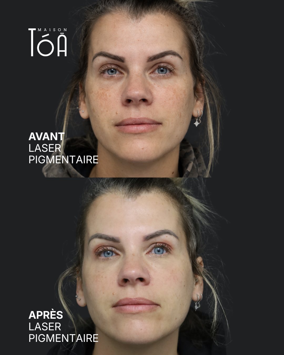 Protocole laser 8 Avant et après, laser pigmentaire, vue de face