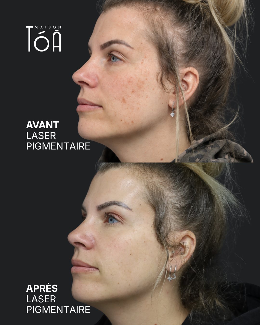 Protocole laser 9 Avant et après, laser pigmentaire, vue de trois quarts