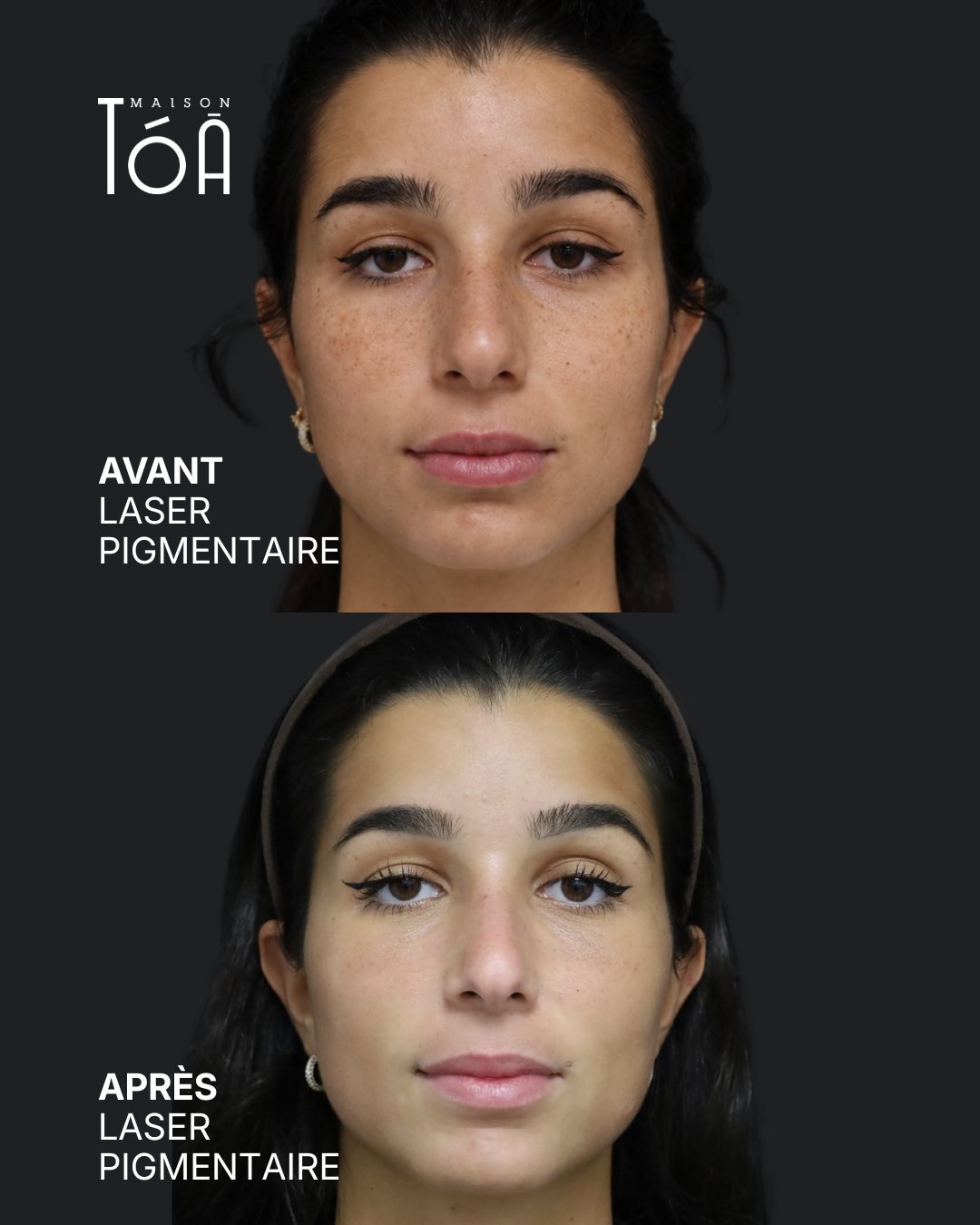 Protocole laser 13 Avant et après, laser pigmentaire, vue de face