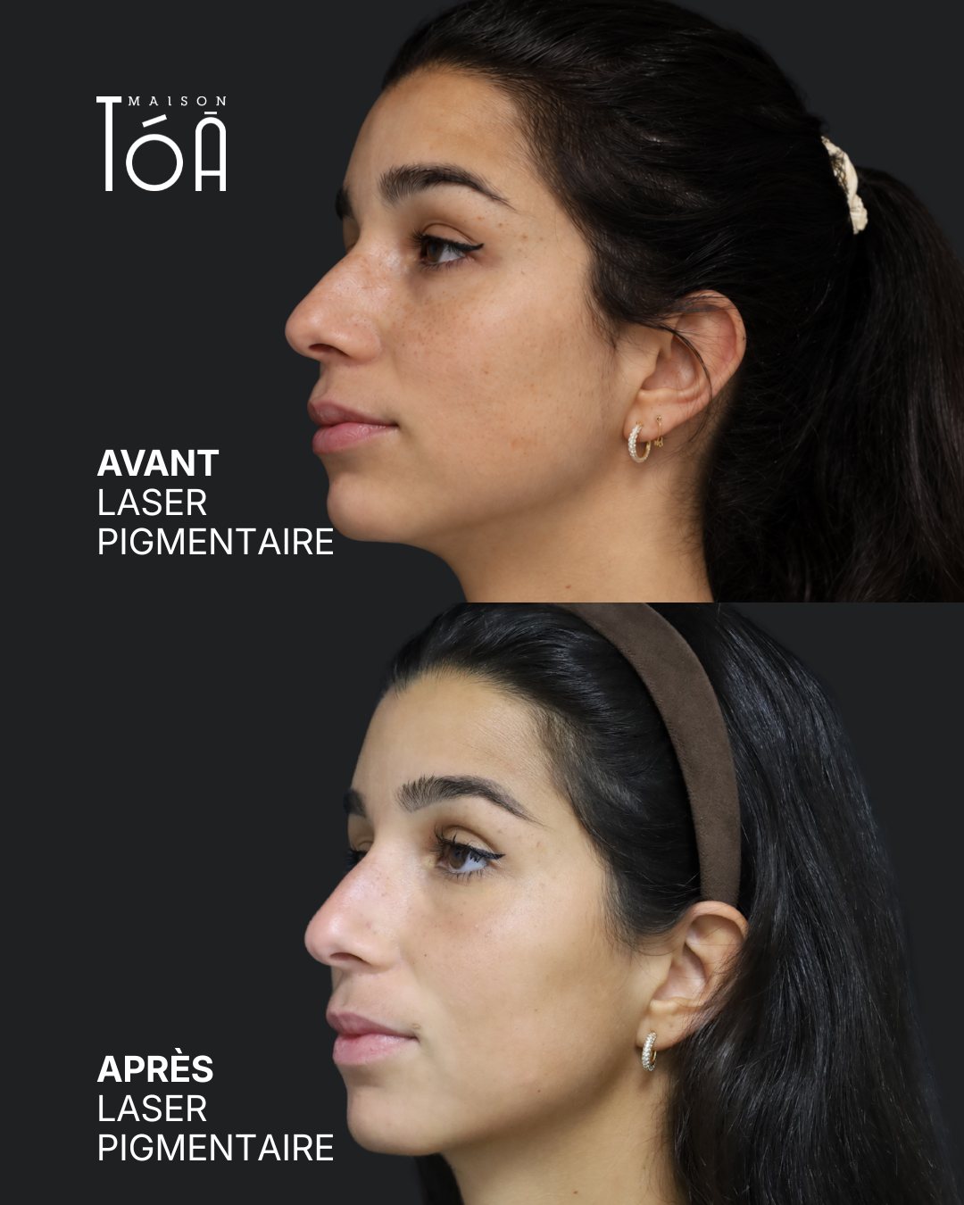 Protocole laser 14 Avant et après, laser pigmentaire, vue de profil