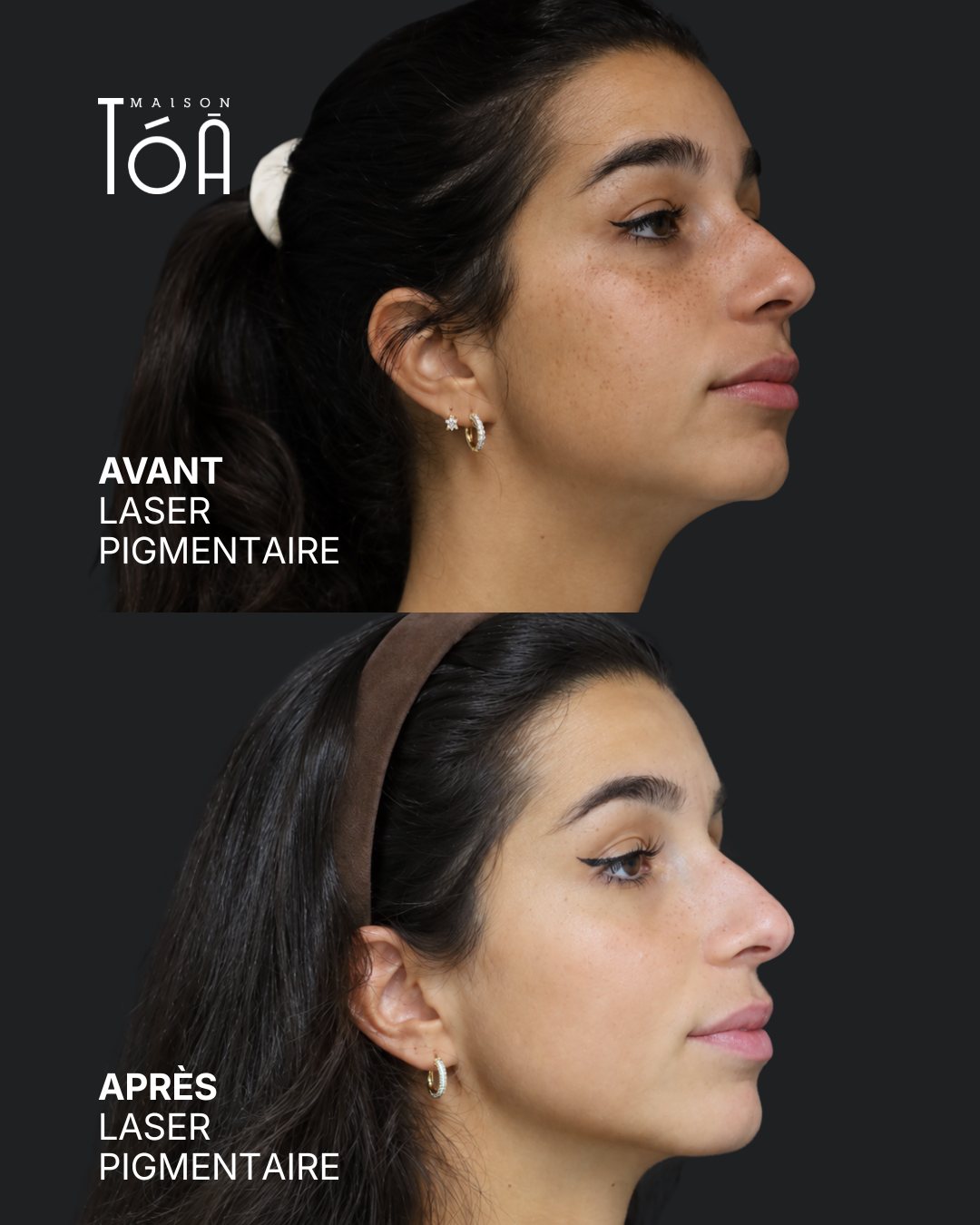 Protocole laser 15 Avant et après, laser pigmentaire, vue de trois quarts