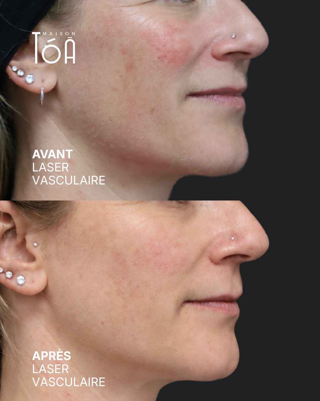 Protocole laser 20 Avant et après, laser vasculaire, détail de la joue