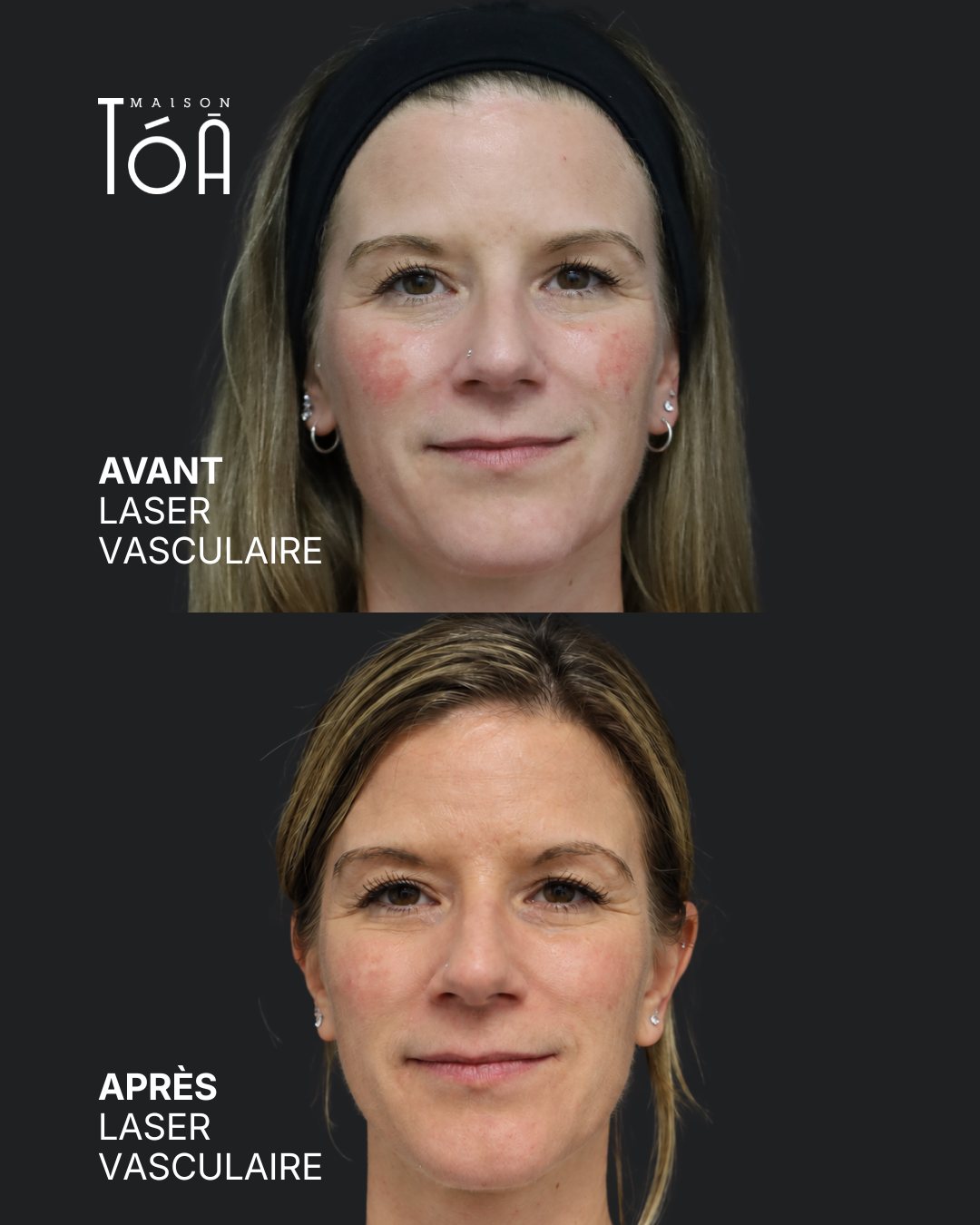 Protocole laser 17 Avant et après, laser vasculaire, vue de face
