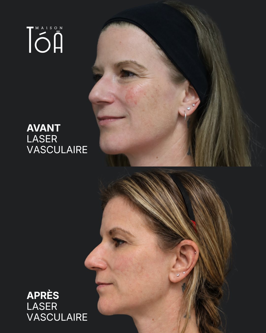 Protocole laser 18 Avant et après, laser vasculaire, vue de profil
