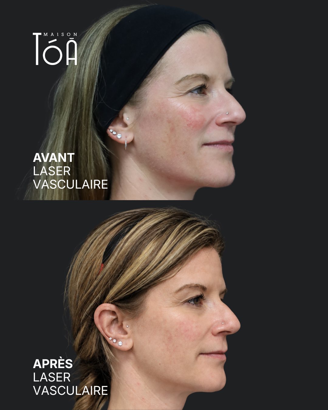 Protocole laser 19 Avant et après, laser vasculaire, vue de trois quarts