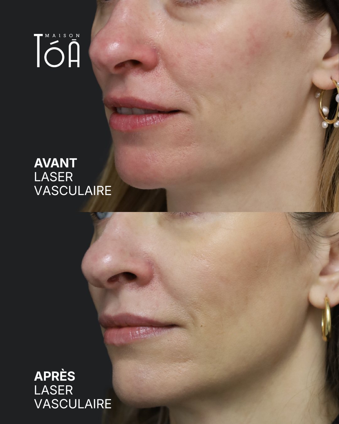 Protocole laser 23 Avant et après, laser vasculaire, détail de la joue