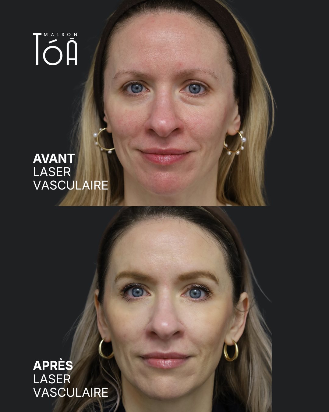 Protocole laser 21 Avant et après, laser vasculaire, vue de face