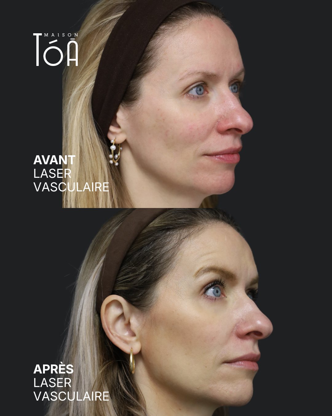 Protocole laser 24 Avant et après, laser vasculaire, vue de profil