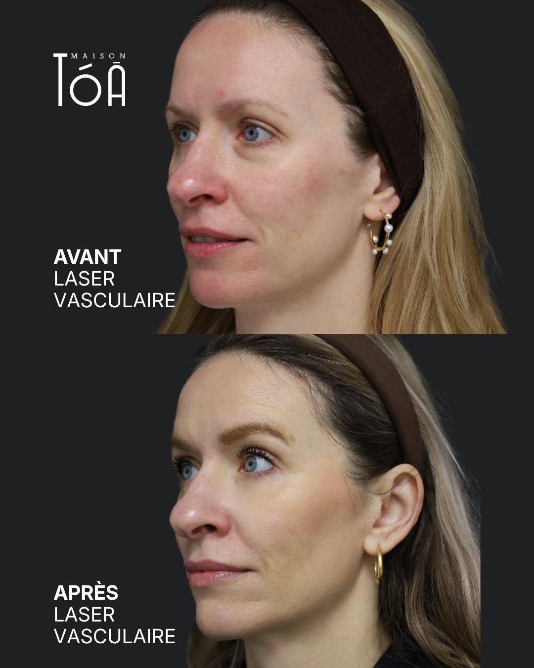 Protocole laser 22 Avant et après, laser vasculaire, vue de trois quarts