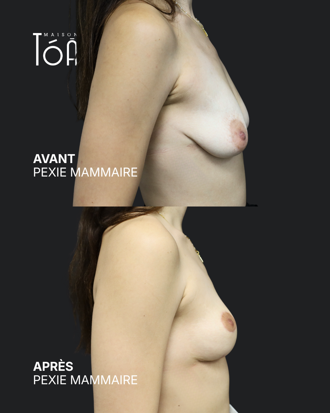 Breast pexy 5 Breast lift before/after, result 1, Maison Tóā Lausanne