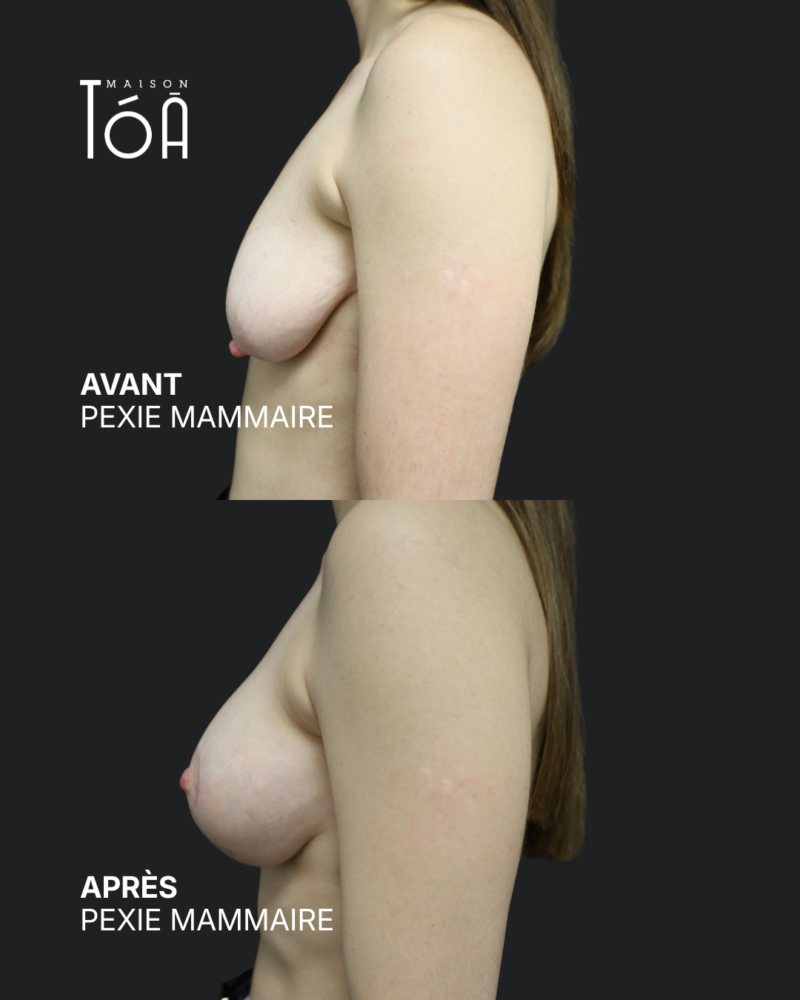 Breast pexy 11 Breast lift before/after, result 7, Maison Tóā Lausanne