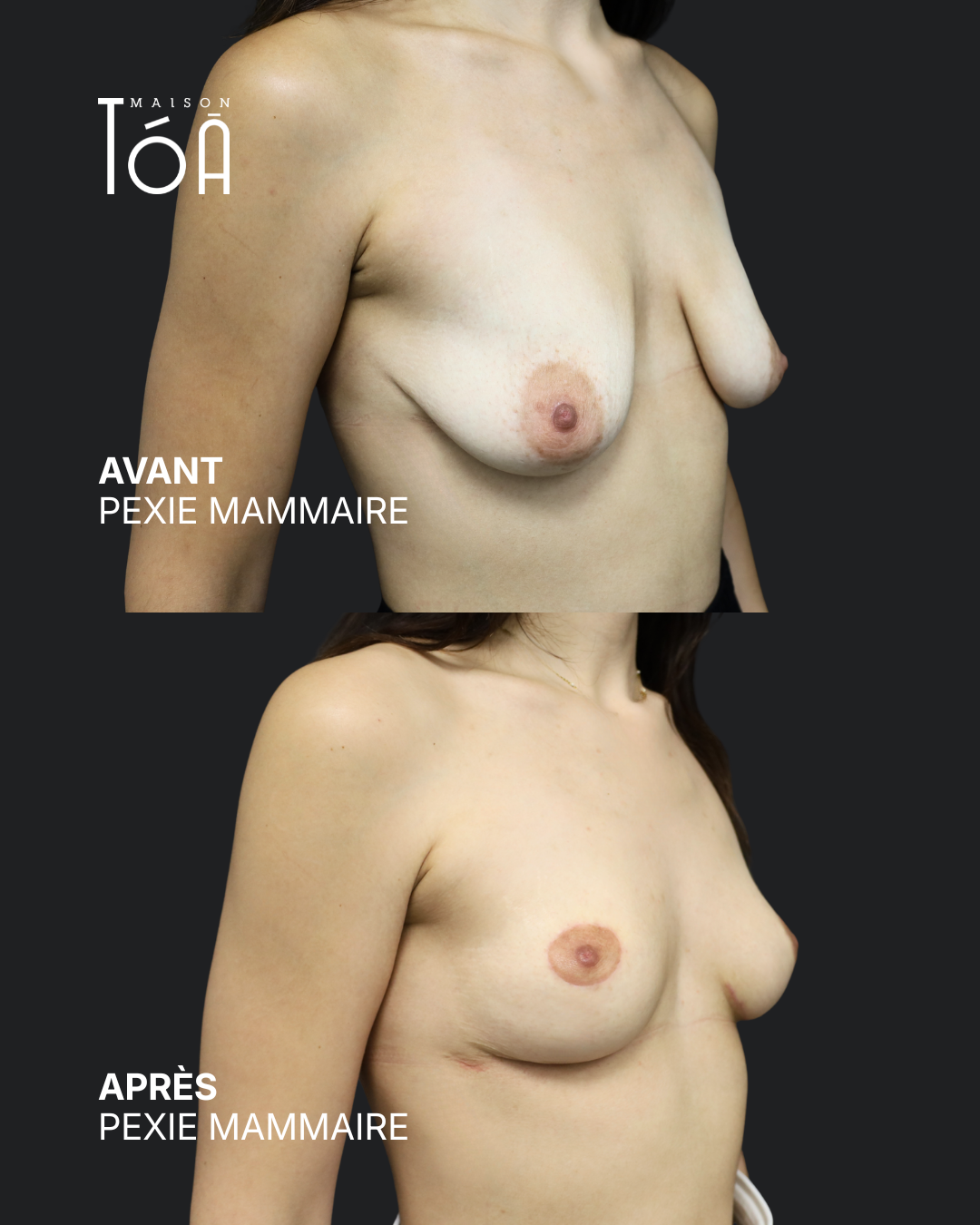 Breast pexy 6 Breast lift before/after, result 2, Maison Tóā Lausanne